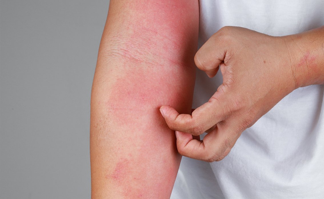 Eczema and Fungus Treatments
